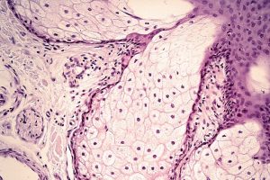 Beyond the Surface: Modern Management of Acne Vulgaris