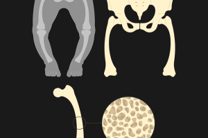 Recognising and managing rare bone disorders in clinical practice
