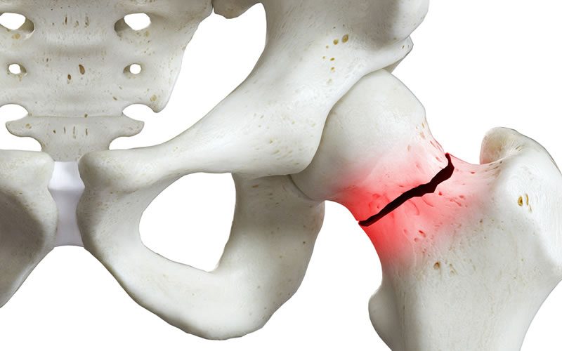 burden-of-osteoporosis-lrg